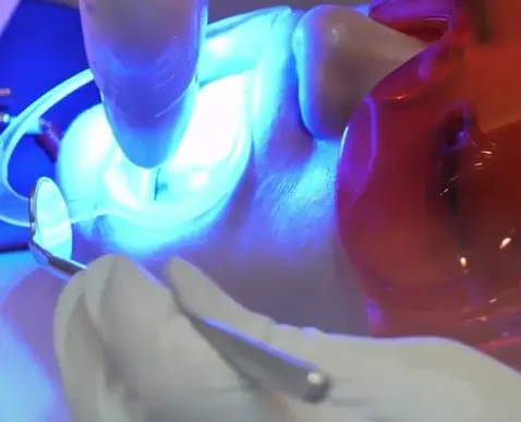 procedimento de clareamento dental