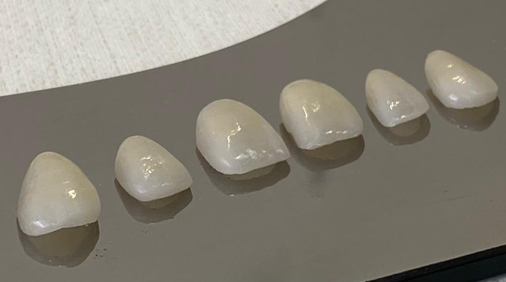 facetas de ceramica