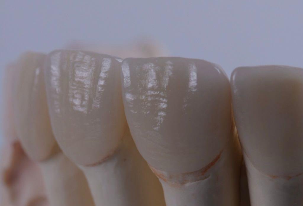 Pessoa em tratamento estético dental