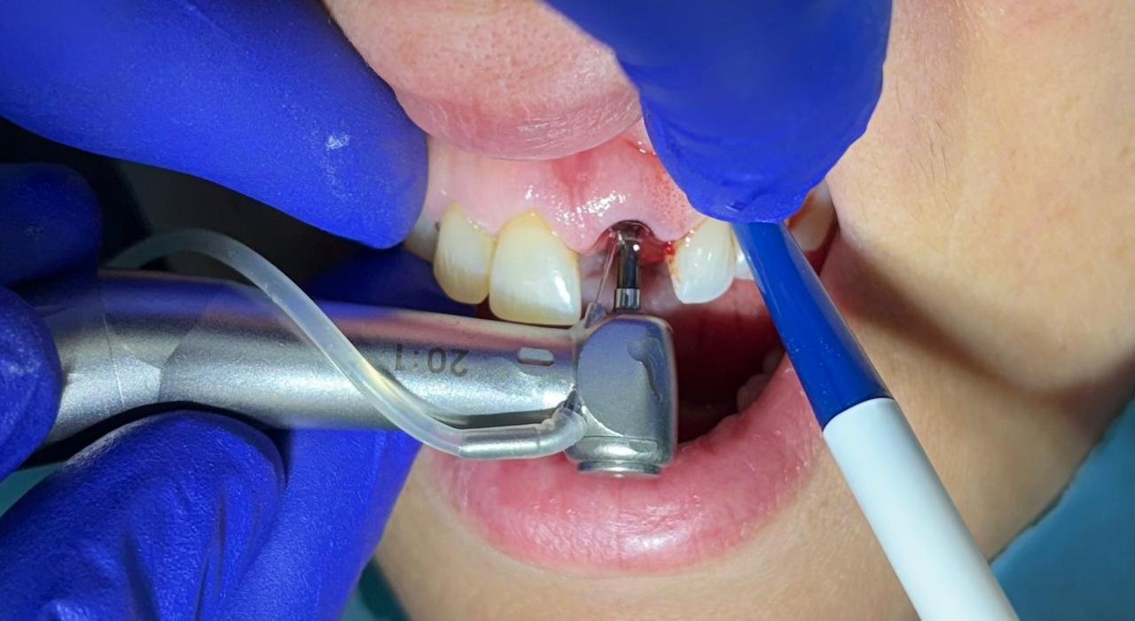 implantes dentários vistos de frente