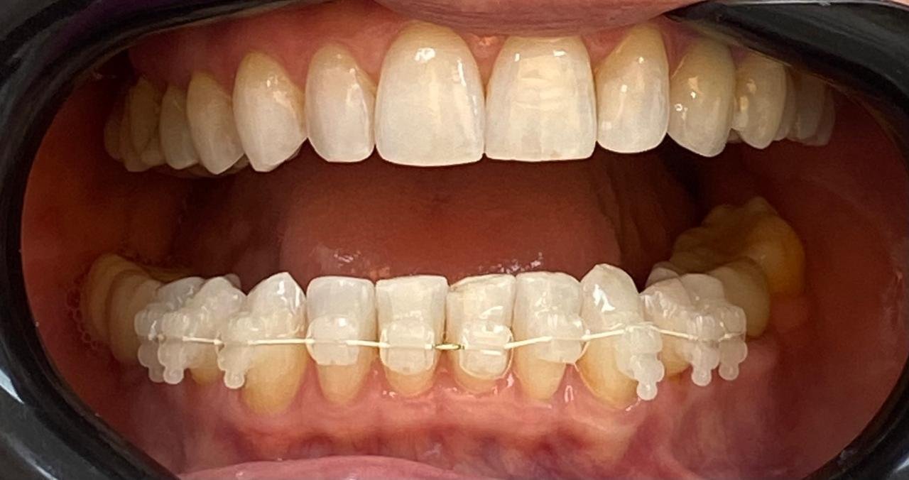 dentes com aparelhos inferiores