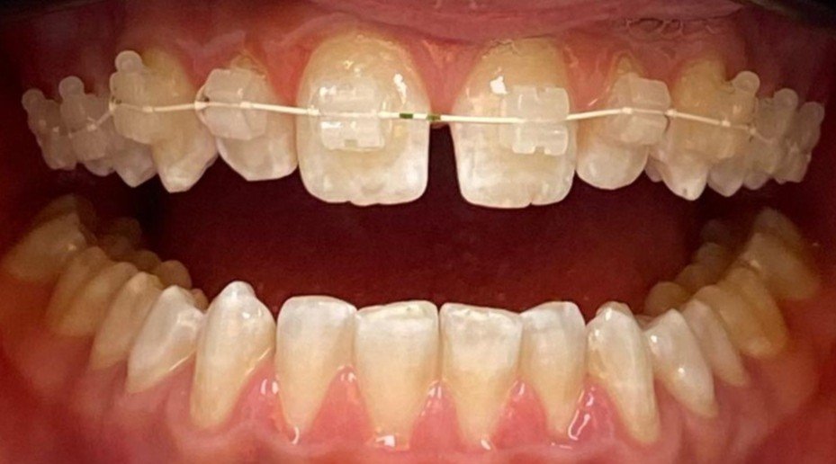 Dentes com aparelhos ortodônticos